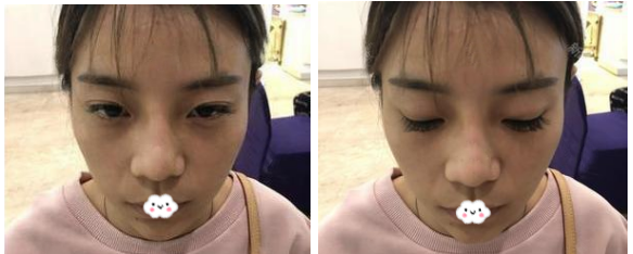做完埋线双眼皮修复两个月了就问你们美不美?我自己感觉修复得很成功哦