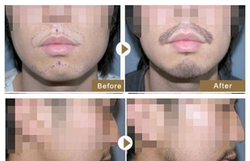 别怕!男人丢掉的“面子”可以通过胡须种植重新捡回来 图2