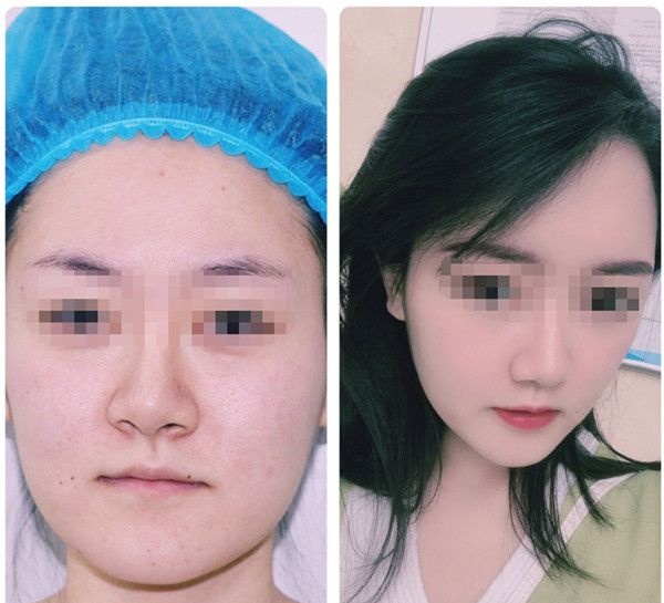 笑话我脸大还去做脂肪填充，看完术后三个月效果，她也偷偷去填充了160ml