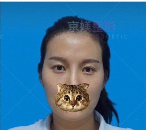自体脂肪填充术后不仅太阳穴、苹果肌变饱满 就连显老的泪沟也不见了