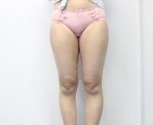 大腿环吸后晚上真的超级疼,但看到效果后说句实话不后悔