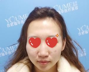 脂肪填充面部打卡记录:术后70天到院复诊医生说脂肪已经成活50%左右