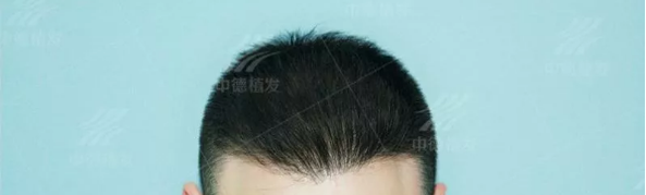 沈先生的坎坷种发路:UFT-高密显微毛发移植术拯救了2次植发失败濒临绝望的我 图2