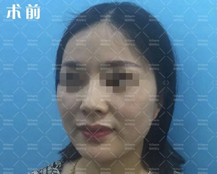 不私藏来分享我做的面部埋线提升手术后并没有你们想象中老的那么快