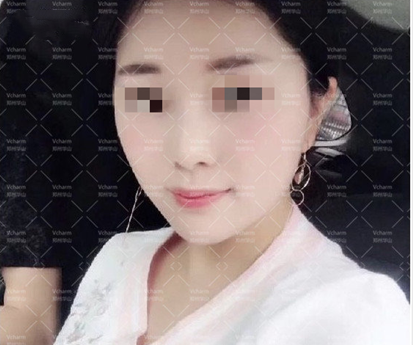 不私藏来分享我做的面部埋线提升手术后并没有你们想象中老的那么快 图2