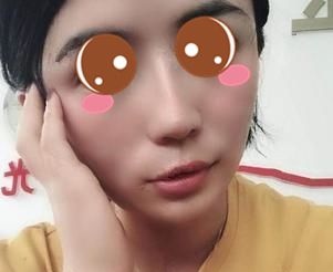 只用了2支海薇玻尿酸垫下巴,就同时改善了我这面部扁平、短下巴的面容