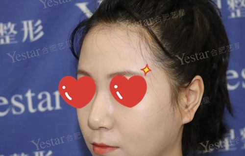 跟你们分享下驼峰鼻矫正后的亲身经历,就知道这个手术到底有没有风险了