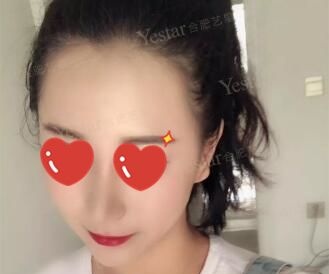 跟你们分享下驼峰鼻矫正后的亲身经历，就知道这个手术到底有没有风险了 案例图2