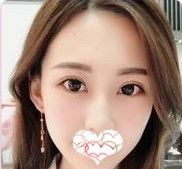 只有做一次眼综合手术才能体会到一双网红大眼的魅力 案例图2