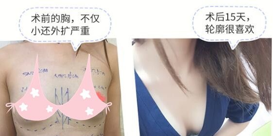 看过对比照+真人反馈，我决定了就在他家做德美茜茜假体丰胸