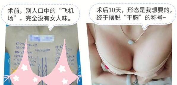 看过对比照+真人反馈,我决定了就在他家做德美茜茜假体丰胸 图2