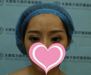 用真人真事告诉你脂肪填充太阳穴术后为什么不能大笑