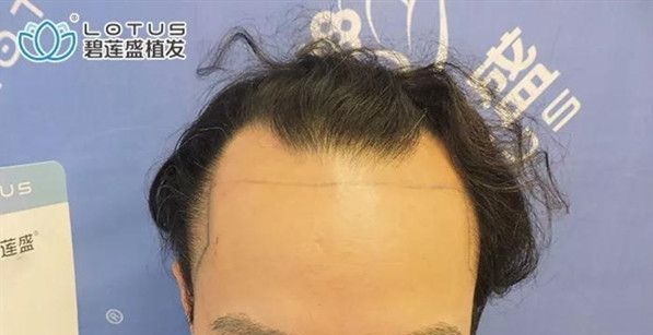 前额发际线种植1年了,我想跟大家唠唠”植发完又脱发“的那些事儿