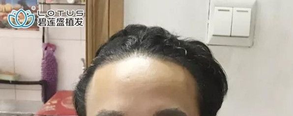 前额发际线种植1年了，我想跟大家唠唠”植发完又脱发“的那些事儿 案例图2