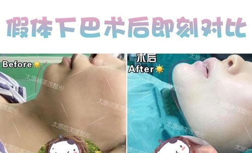 担心硅胶垫下巴术后容易被看穿,别着急先来看看她们怎么说