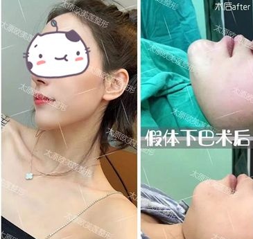 担心硅胶垫下巴术后容易被看穿,别着急先来看看她们怎么说 图2