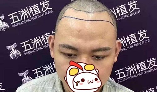 虽然我额头发际线光秃部位的毛囊已经闭合,但是植发让它“发芽复活”!