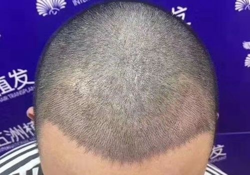 虽然我额头发际线光秃部位的毛囊已经闭合,但是植发让它“发芽复活”! 图2