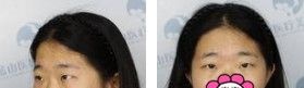 后悔自己没早做全切双眼皮+开内眼角+上睑提肌手术 白白丑了28年