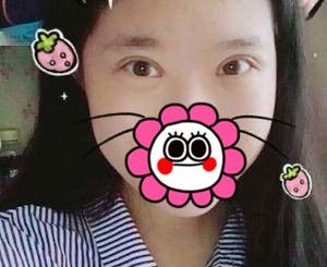 后悔自己没早做全切双眼皮+开内眼角+上睑提肌手术 白白丑了28年 案例图2