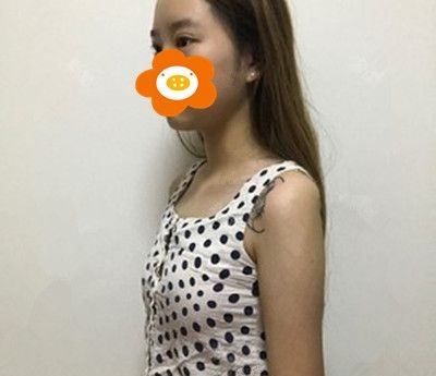 因为信任所以选择,自曝做花样年华假体隆胸手术三个月效果!!!