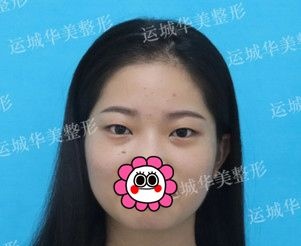 都想知道做微创双眼皮+开眼角疼不疼，那就用真实经历告诉你们