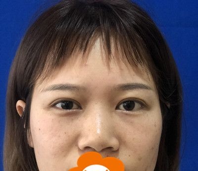 好开心呀!自体软骨垫鼻尖半年后不仅效果自然就连搂鼻子也一点问题都没有