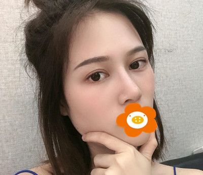 好开心呀!自体软骨垫鼻尖半年后不仅效果自然就连搂鼻子也一点问题都没有 图2