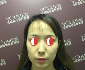 22岁出现皮肤下垂初老症状不要怕,埋线提升抗衰比较要有姓名