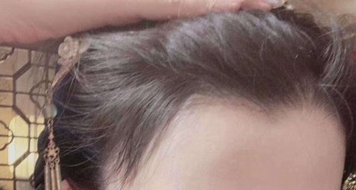 我额头发际线高达五指宽!医生给我设计了美人尖发际线调整方案 图2