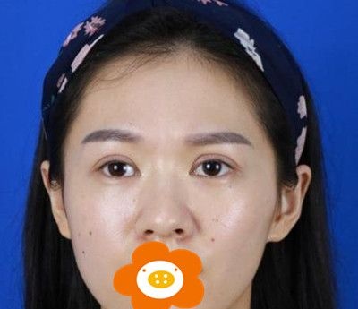 双眼皮失败修复已经3个月了！一起来感受下被我喜欢的眼睛吧！