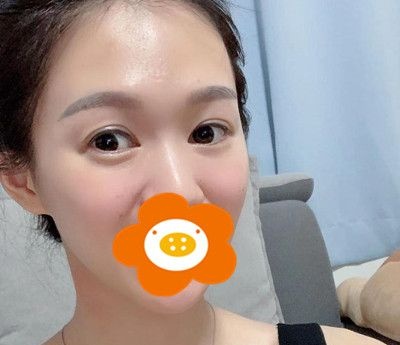双眼皮失败修复已经3个月了!一起来感受下被我喜欢的眼睛吧! 图2