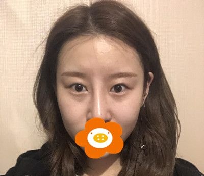 做了双眼皮综合手术半年时间宽度和弧度我都满意，今天来说下感受！