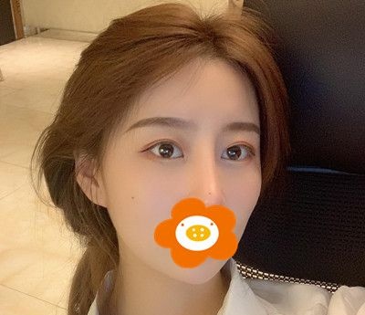 做了双眼皮综合手术半年时间宽度和弧度我都满意，今天来说下感受！ 案例图2