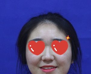 害怕面部吸脂术后凹凸不平,所以我选这家医院做了射频溶脂瘦脸别说效果还挺好