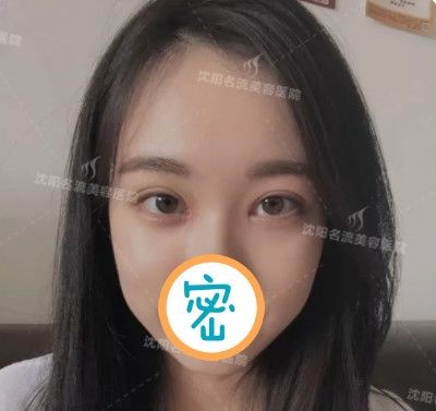 很庆幸当初选择双眼皮和开眼角一起做了,看恢复后水灵灵的大眼睛很撩人哦! 图2