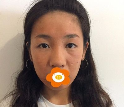 本来还纠结双眼皮和隆鼻先做哪个,谁知两个一起做的效果超出了我的预期!