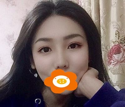 本来还纠结双眼皮和隆鼻先做哪个,谁知两个一起做的效果超出了我的预期! 图2