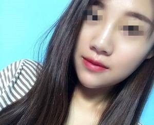 拯救大饼脸不要只想着做面部吸脂手术其实膨体垫下巴也有超棒的瘦脸效果 案例图2