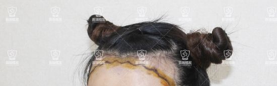95后小姐姐来分享圆弧形发际线种植经历,为了变美!所以“植”得