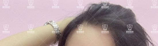 95后小姐姐来分享圆弧形发际线种植经历,为了变美!所以“植”得 图2