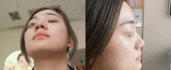 温莎假体隆鼻+耳软骨垫鼻尖的鼻综合整形拯救了伴随有朝天短鼻的我