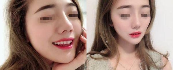 温莎假体隆鼻+耳软骨垫鼻尖的鼻综合整形拯救了伴随有朝天短鼻的我 图2