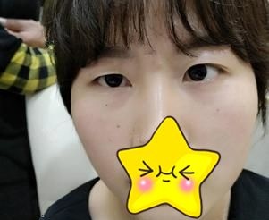 都以为我花了一万多做眼综合才改善了大小眼,其实只花了不到一半的价钱
