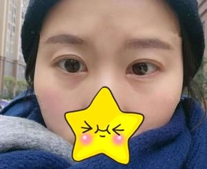 都以为我花了一万多做眼综合才改善了大小眼,其实只花了不到一半的价钱 图2
