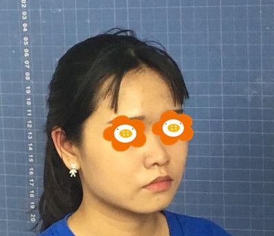 听说面部埋线提升手术维持时间不长，但看我恢复3个月效果也算是吃了一颗定心丸