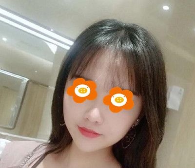 听说面部埋线提升手术维持时间不长,但看我恢复3个月效果也算是吃了一颗定心丸 图2