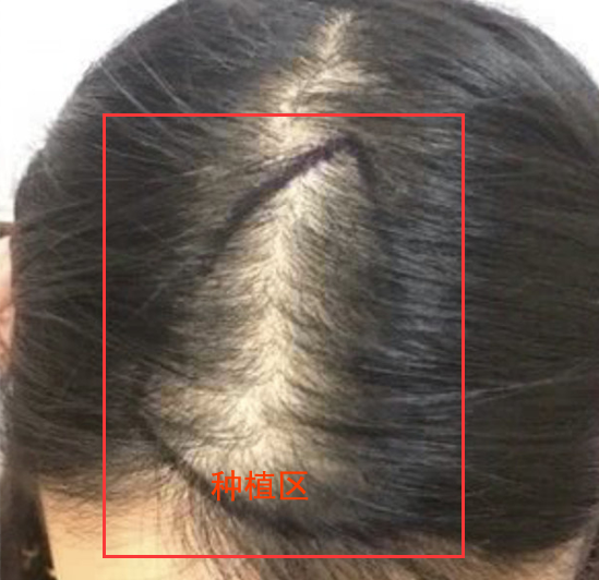 作为一个女性雄激素脱发患者,我选择了头顶加密种植挽回形象