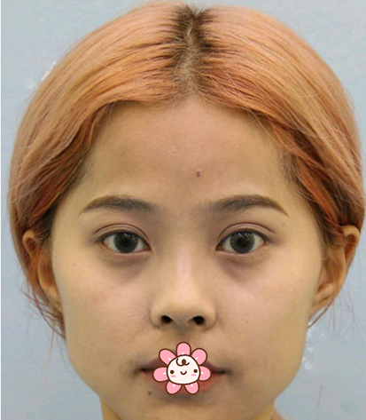 傻了吧唧以为拔牙脸就能变小结果医生给我做了面部轮廓三件套和全脸脂肪填充