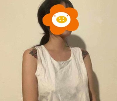 产后乳房干瘪下垂想改善？那就来看我花样年华假体隆胸6个月恢复效果